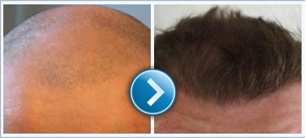 Hair transplant